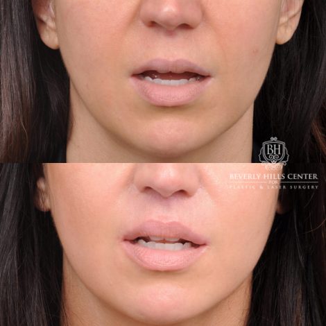 Beverly Hills Center Male Patient Before and After Lip Lift