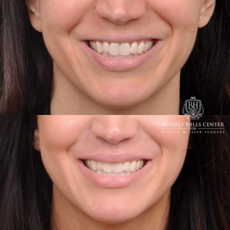 Beverly Hills Center Male Patient Before and After Lip Lift