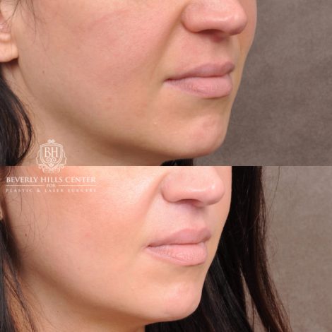Beverly Hills Center Male Patient Before and After Lip Lift