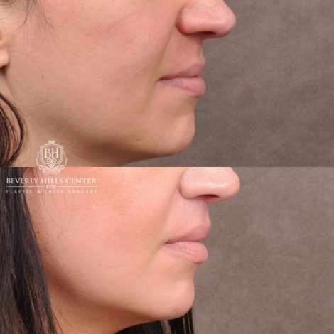 Beverly Hills Center Male Patient Before and After Lip Lift