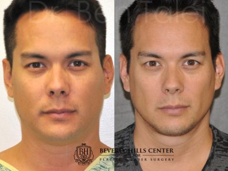 Beverly Hills Center Male Patient Before and After Micro-Liposuction of the Neck and Chin Procedures