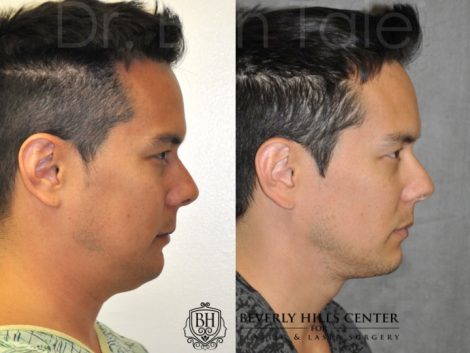 Beverly Hills Center Male Patient Before and After Micro-Liposuction of the Neck and Chin Procedures