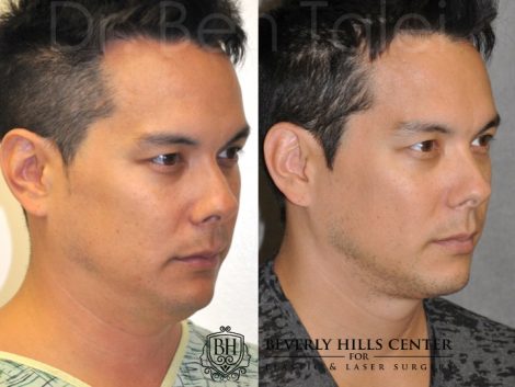 Beverly Hills Center Male Patient Before and After Micro-Liposuction of the Neck and Chin Procedures