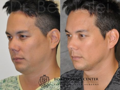 Beverly Hills Center Male Patient Before and After Micro-Liposuction of the Neck and Chin Procedures
