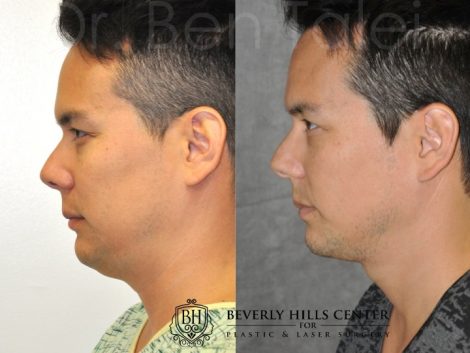 Beverly Hills Center Male Patient Before and After Micro-Liposuction of the Neck and Chin Procedures
