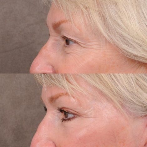 Beverly Hills Center Female Patient Comprehensive AuraLyft