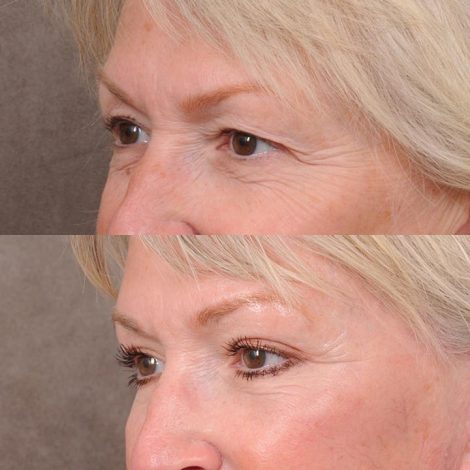 Beverly Hills Center Female Patient Comprehensive AuraLyft