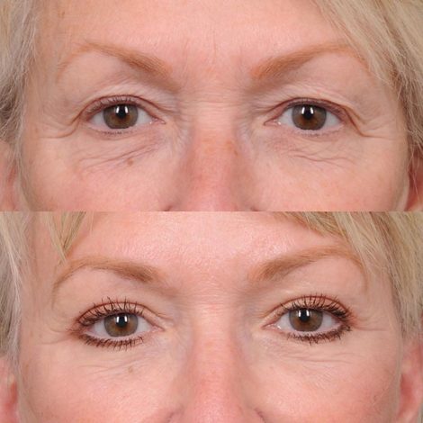 Beverly Hills Center Female Patient Comprehensive AuraLyft