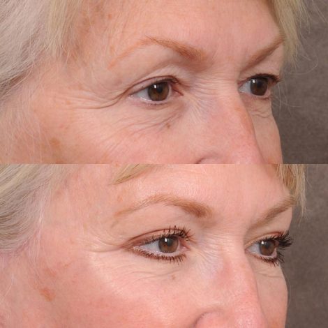 Beverly Hills Center Female Patient Comprehensive AuraLyft