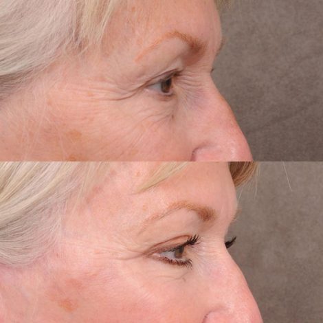 Beverly Hills Center Female Patient Comprehensive AuraLyft