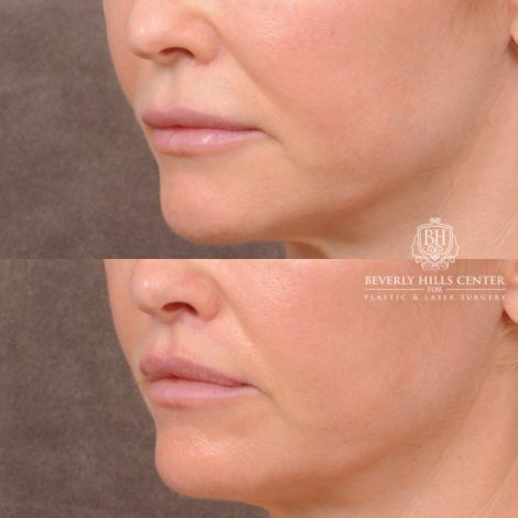 Beverly Hills Center Female Patient Before and After CUPID LIFT® Corner Lift & Profound (Lower Face)