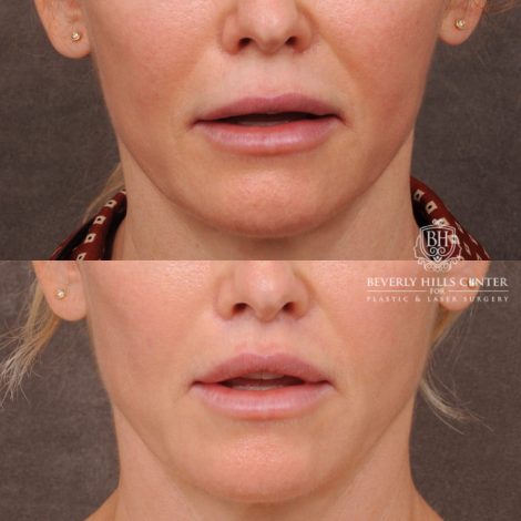 Beverly Hills Center Female Patient Before and After CUPID LIFT® Corner Lift & Profound (Lower Face)