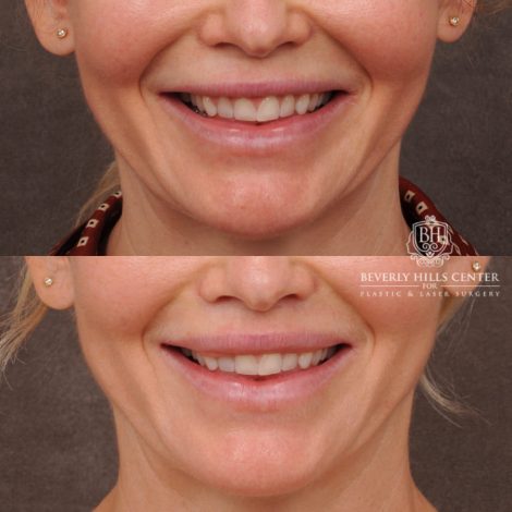 Beverly Hills Center Female Patient Before and After CUPID LIFT® Corner Lift & Profound (Lower Face)