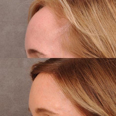 Beverly Hills Center Female Patient Before and After Foreheadplasty