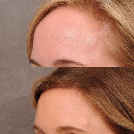 Beverly Hills Center Female Patient Before and After Foreheadplasty