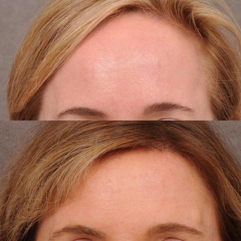 Beverly Hills Center Female Patient Before and After Foreheadplasty