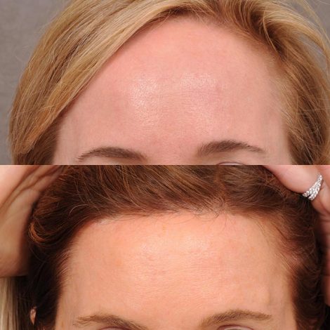 Beverly Hills Center Female Patient Before and After Foreheadplasty