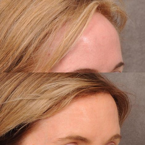 Beverly Hills Center Female Patient Before and After Foreheadplasty