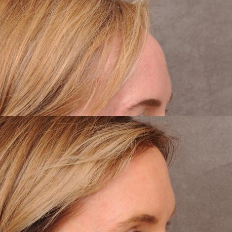 Beverly Hills Center Female Patient Before and After Foreheadplasty