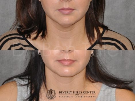Beverly Hills Center Female Patient Before and After Micro-Liposuction of the Neck and Chin Procedure