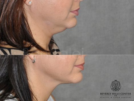Beverly Hills Center Female Patient Before and After Micro-Liposuction of the Neck and Chin Procedure