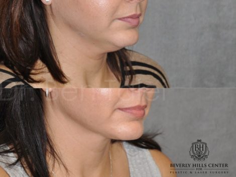 Beverly Hills Center Female Patient Before and After Micro-Liposuction of the Neck and Chin Procedure