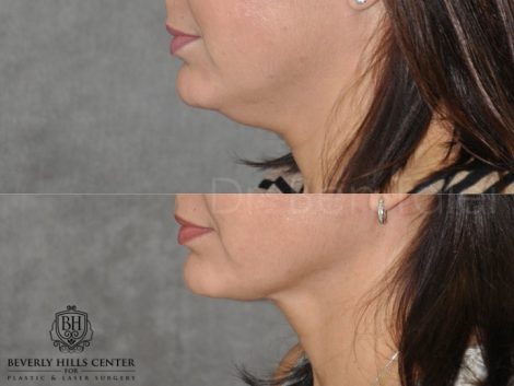 Beverly Hills Center Female Patient Before and After Micro-Liposuction of the Neck and Chin Procedure