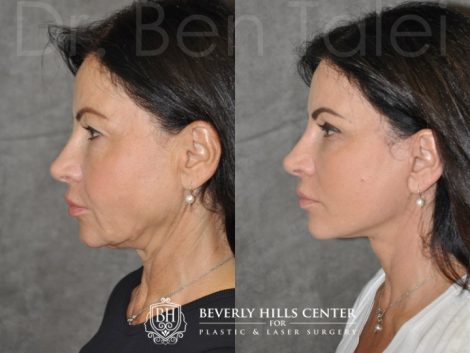 Beverly Hills Center Female Patient Before and After Auralyft with Upper and Lower eyelid rejuvenation