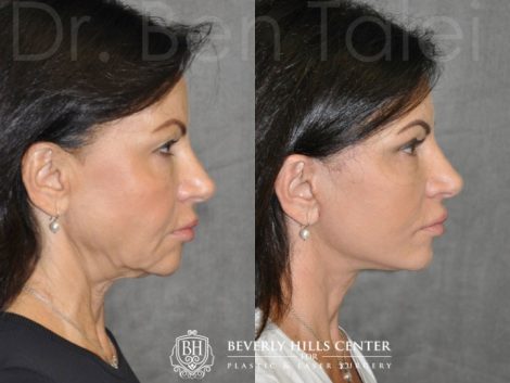 Beverly Hills Center Female Patient Before and After Auralyft with Upper and Lower eyelid rejuvenation