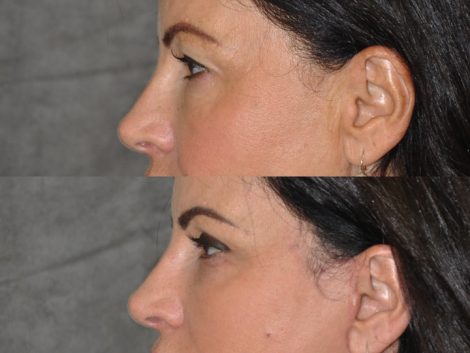 Beverly Hills Center Female Patient Before and After Auralyft with Upper and Lower eyelid rejuvenation
