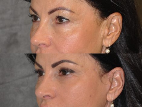 Beverly Hills Center Female Patient Before and After Auralyft with Upper and Lower eyelid rejuvenation