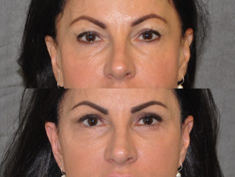 Beverly Hills Center Female Patient Before and After Auralyft with Upper and Lower eyelid rejuvenation