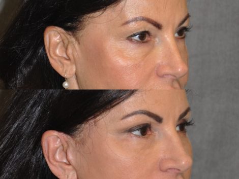 Beverly Hills Center Female Patient Before and After Auralyft with Upper and Lower eyelid rejuvenation