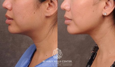 Beverly Hills Center Female Patient Before and After Profound Rf