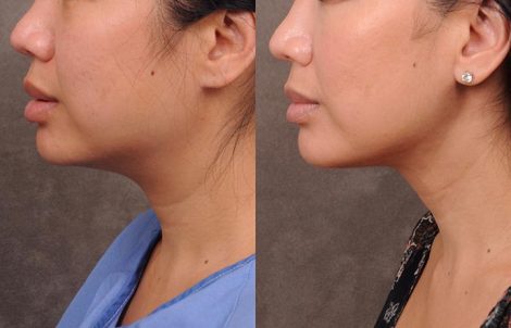 Beverly Hills Center Female Patient Before and After Weekend Neck Lift
