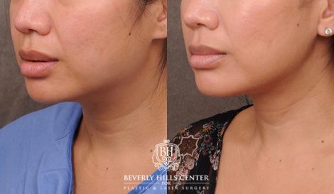 Beverly Hills Center Female Patient Before and After Profound Rf