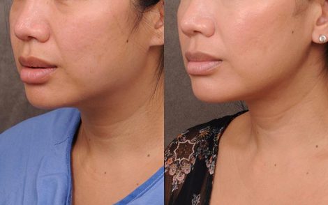 Beverly Hills Center Female Patient Before and After Weekend Neck Lift