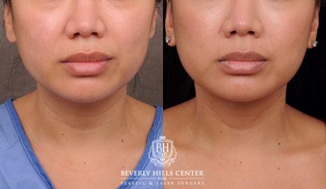 Beverly Hills Center Female Patient Before and After Profound Rf