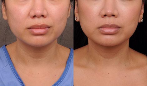 Beverly Hills Center Female Patient Before and After Weekend Neck Lift