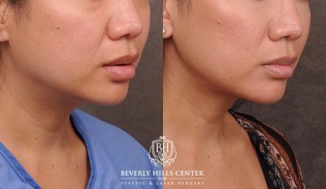 Beverly Hills Center Female Patient Before and After Profound Rf