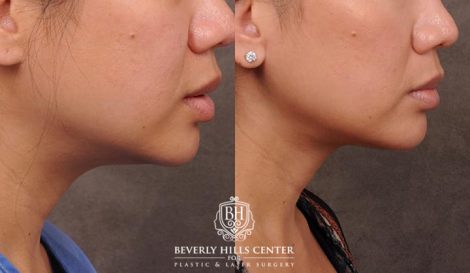 Beverly Hills Center Female Patient Before and After Profound Rf