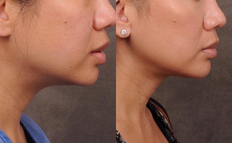 Beverly Hills Center Female Patient Before and After Weekend Neck Lift