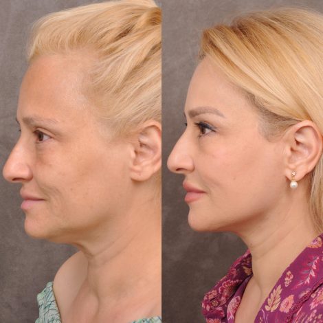 Beverly Hills Center Female Patient Before and After AuraLyft & Hybrid Brow Lift