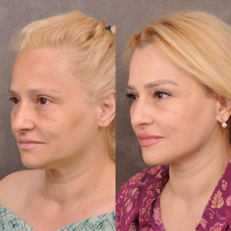 Beverly Hills Center Female Patient Before and After AuraLyft & Hybrid Brow Lift