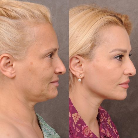 Beverly Hills Center Female Patient Before and After AuraLyft & Hybrid Brow Lift