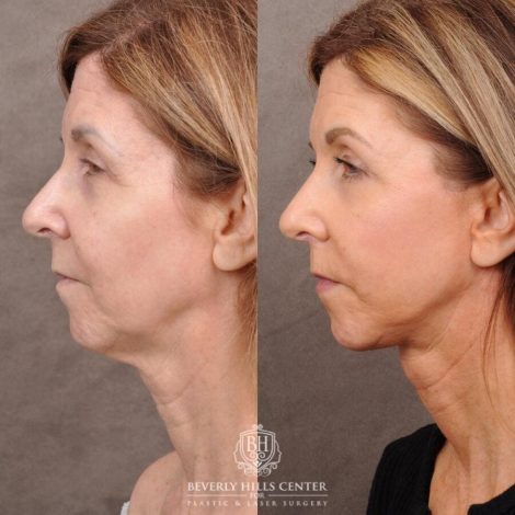 Beverly Hills Center Male Patient Before and After AuraLyft