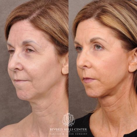Beverly Hills Center Male Patient Before and After AuraLyft