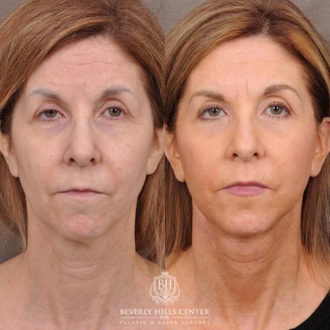 Beverly Hills Center Male Patient Before and After AuraLyft
