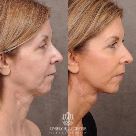 Beverly Hills Center Male Patient Before and After AuraLyft