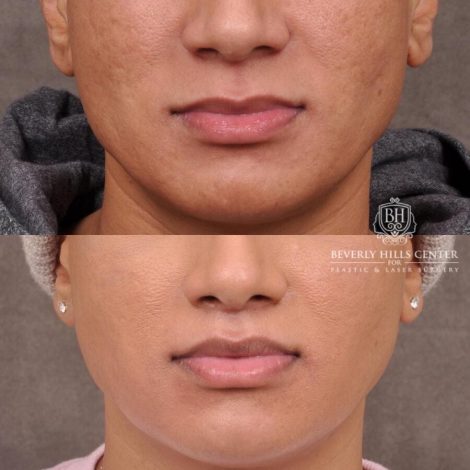 Beverly Hills Center Male Patient Before and After Modified Upper Lip Lift Deep Plane Release